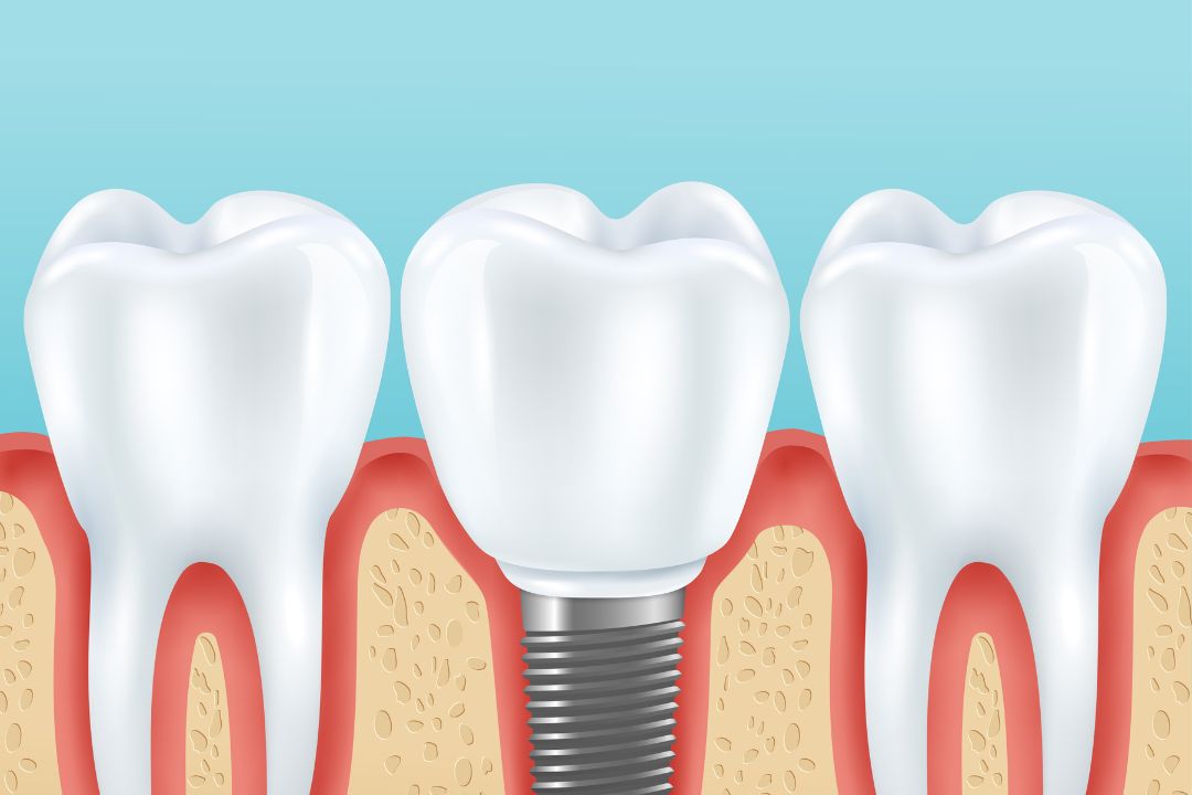 dental implants